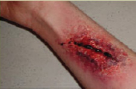 Fresh Wound Healing with Skiinprot